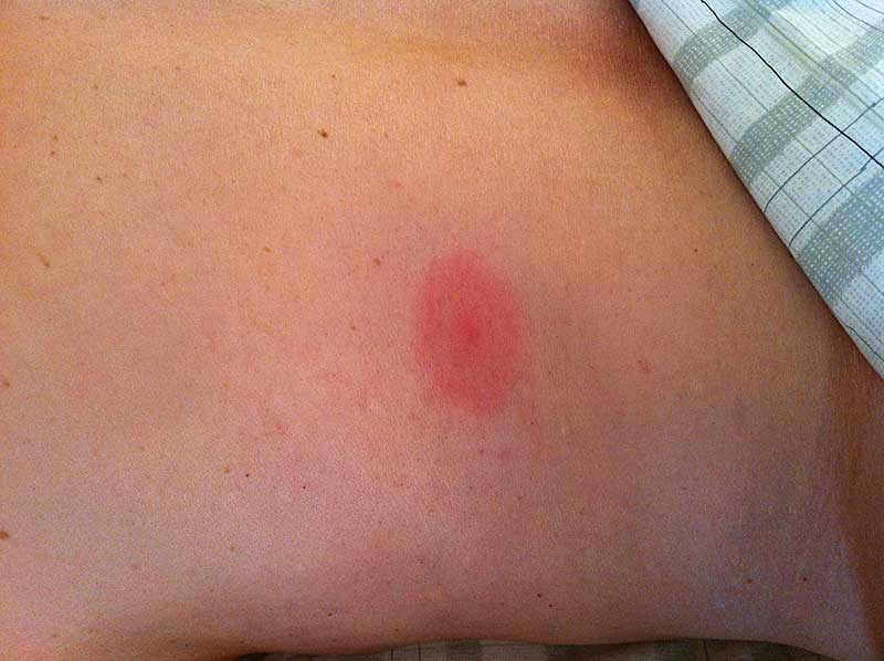 picture of lyme disease bite